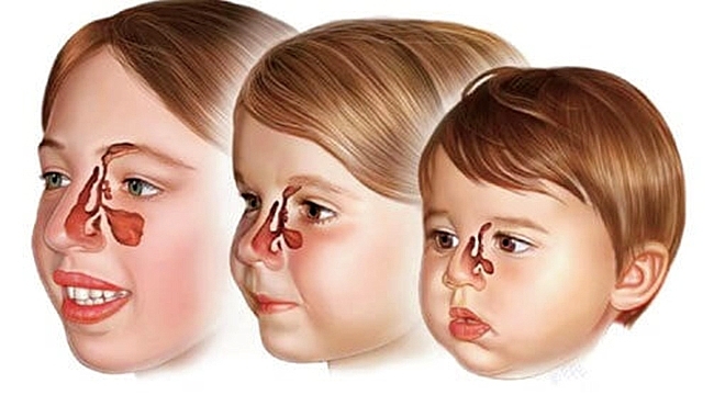ÇOCUKLARDA SİNÜZİTİN 12 BELİRTİSİNE DİKKAT!
